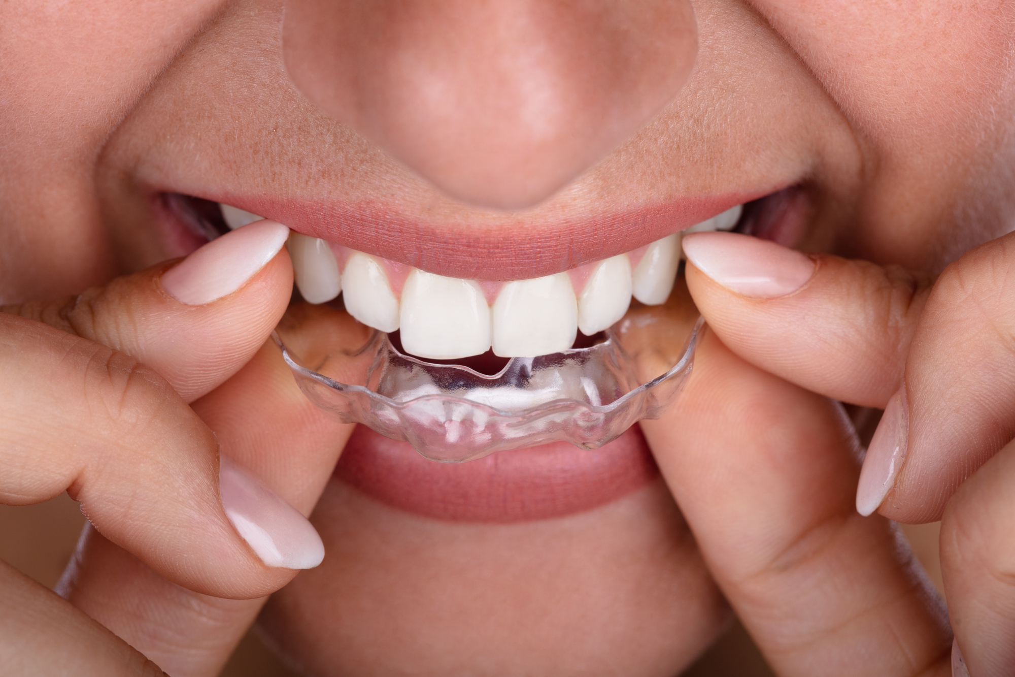 Clear Braces vs Invisalign: Wich is the better option in 2024